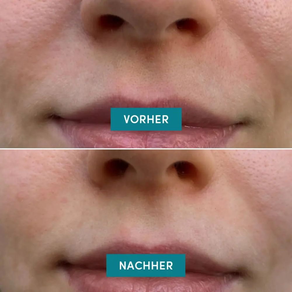 APRICOT Mundfalten Pads "kiss it better" mit Ectoin · 100 Behandlungen – Bild 4